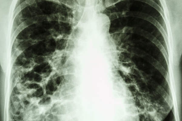 Fibrosis pulmonar - Neumólogo Málaga